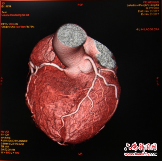 六安市第四人民医院开展CT血管造影即CTA新