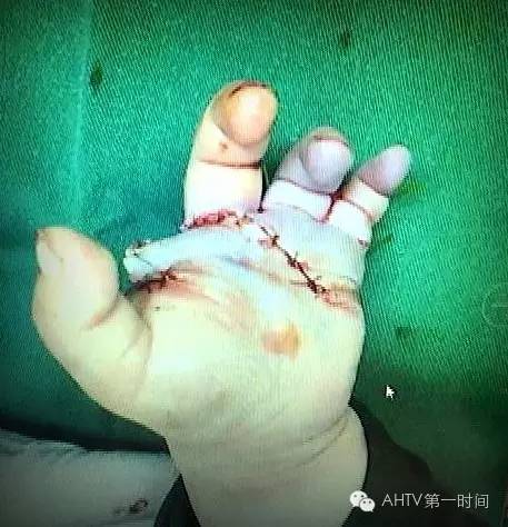 奶奶带两岁孙女逛超市 女童被电梯夹断左手食指