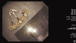 又见家长粗心 11个月大女婴吞耳坠