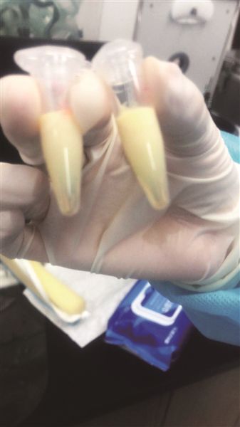 厨师小伙抽出乳白色“牛奶血” 常给自己加餐