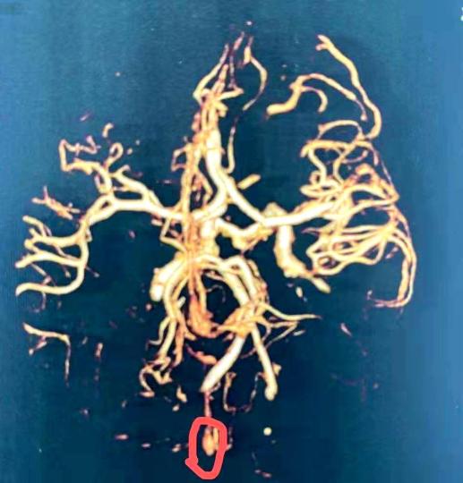 22岁女孩突发颅动脉瘤破裂 专家：或与长期熬夜喝咖啡有关