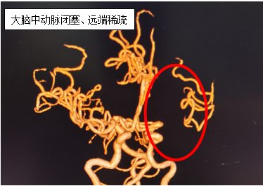 分秒必争 使命必达——56岁患者重获新生