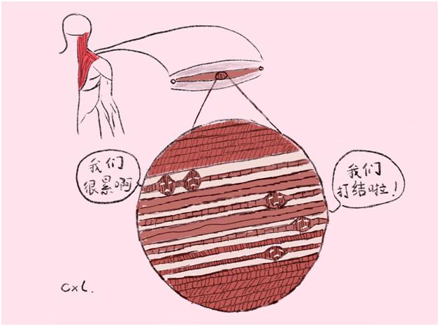 肌肉酸疼总不缓解？当心肌筋膜疼痛综合征