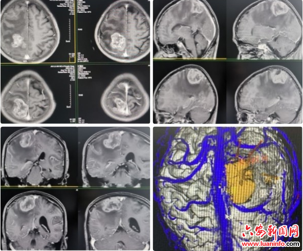 市四院精准智能诊疗迈入新高地 ——六安首例神经外科手术机器人辅助脑肿瘤切除手术